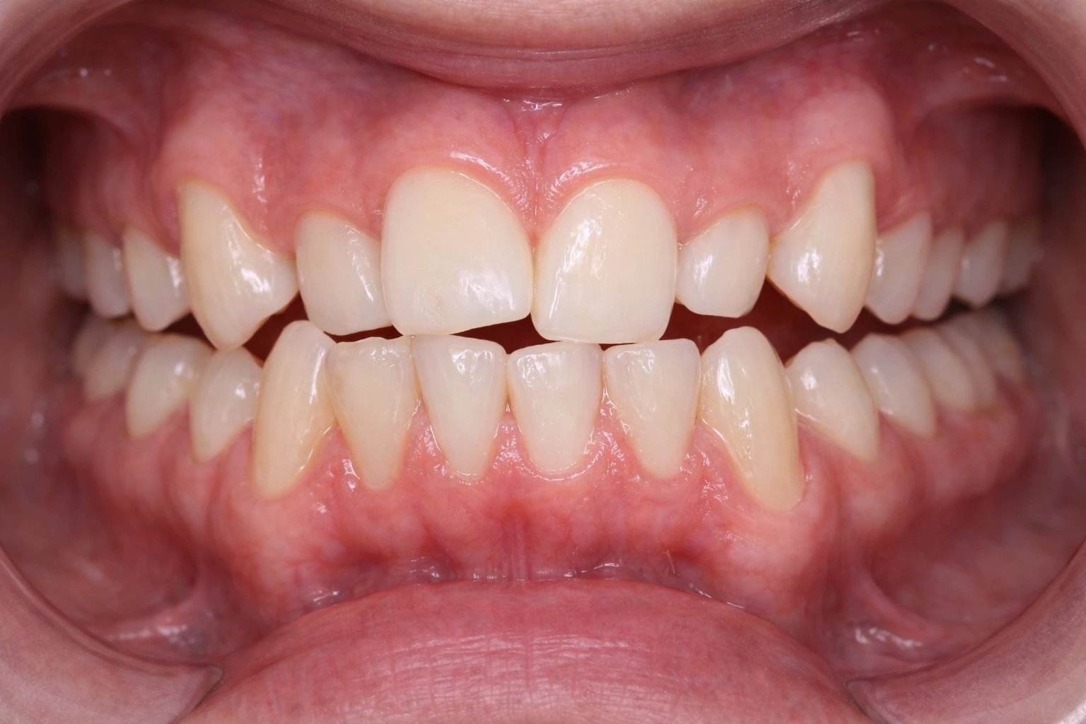 Crossbite Before
